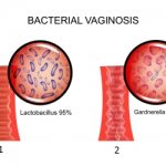1) healthy vaginal mucosa. 2) bacterial vaginosis. 