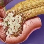 Stage four pancreatic cancer