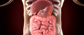 Gastrointestinal stromal tumor