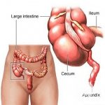 Chronic appendicitis is more common in young women