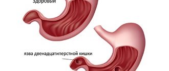 Infiltrative gastric ulcer: causes, symptoms, treatment