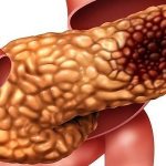 Changes in pancreatic fibrolipomatosis - what is it?