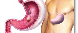 Как происходит операция удаления полипа в желудке