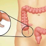 How does appendicitis manifest in adolescents: signs and features of the course of the disease
