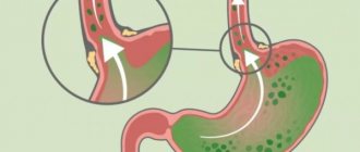 Как желчь попадает в желудок: причины