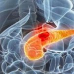 What types of tumors are there on the pancreas?