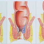Treatment of hemorrhoids and its complications