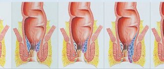 Treatment of hemorrhoids and its complications