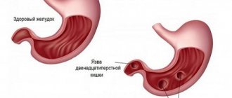 Treatment of stomach ulcers with alcohol - benefit or harm?