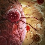 Недифференцированный рак желудка: признаки, как диагностируется и лечится