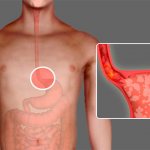 Insufficiency of the lower esophageal sphincter - achalasia cardia
