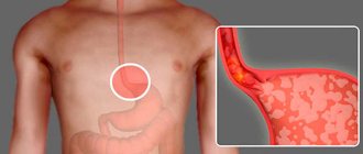 Insufficiency of the lower esophageal sphincter - achalasia cardia