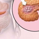 The danger of pancreatic polyp