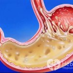 Increased stomach acid causes discomfort