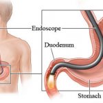 path of the endoscope into the stomach