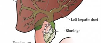 Figure 1. Narrowed or blocked bile duct.