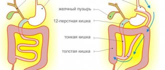Схема шунтирования желудка