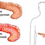 Сравнение вида нормальной и воспаленной поджелудочной