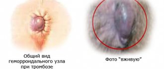 Тромбоз наружного геморроидального узла