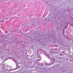 Types of intestinal tumors: adenocarcinoma