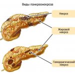 types of pancreatic necrosis