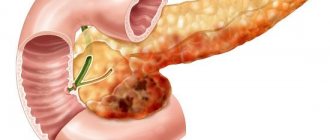 Inflamed pancreas